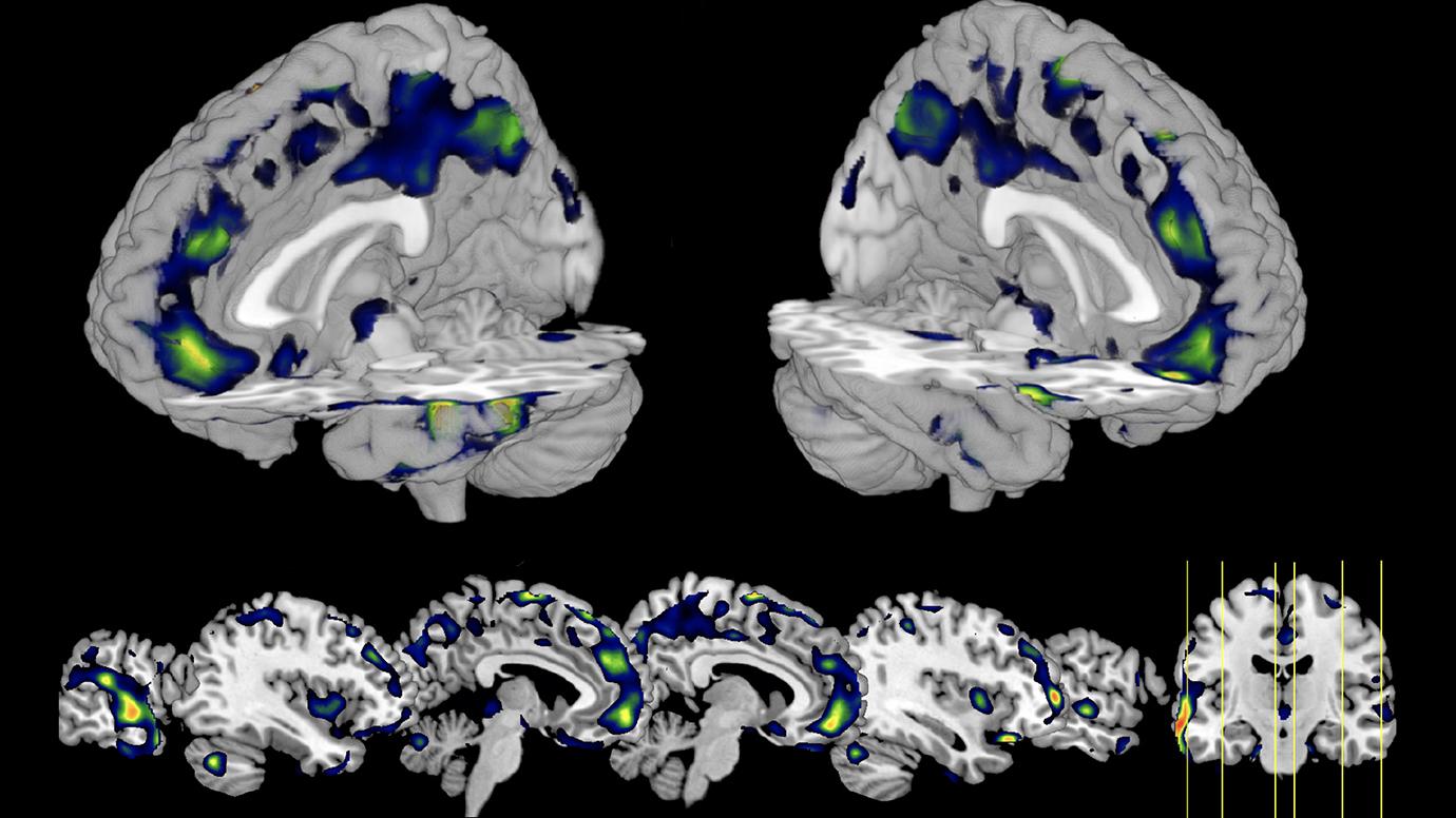 Aberrant gray matter